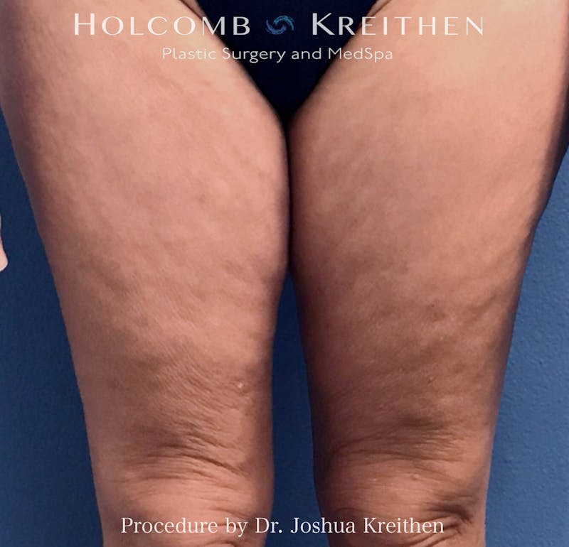 Morpheus  Before & After Gallery - Patient 970478 - Image 2