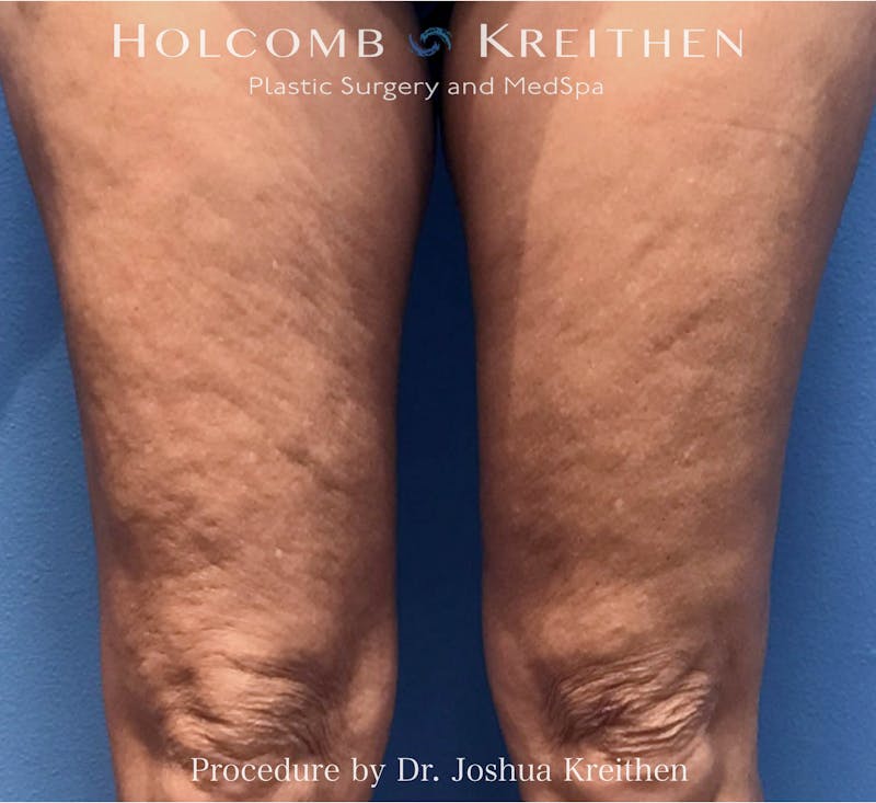 Morpheus  Before & After Gallery - Patient 686421 - Image 1