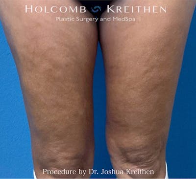 Morpheus  Before & After Gallery - Patient 686421 - Image 2