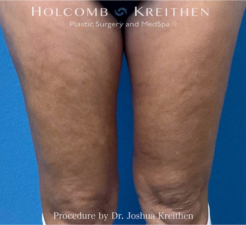 Morpheus  Before & After Gallery - Patient 686421 - Image 2
