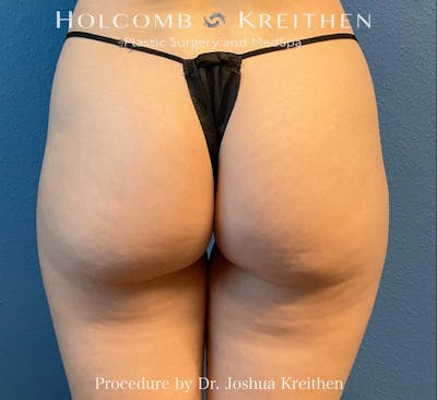 Morpheus  Before & After Gallery - Patient 806479 - Image 1