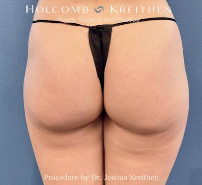 Morpheus  Before & After Gallery - Patient 806479 - Image 2