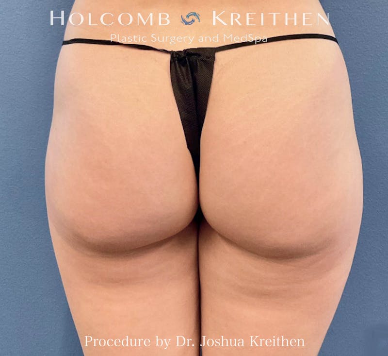 Morpheus  Before & After Gallery - Patient 806479 - Image 2