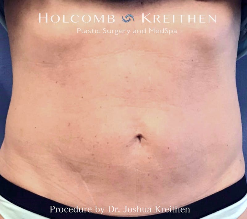 Morpheus  Before & After Gallery - Patient 181326 - Image 2