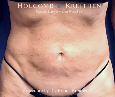 Morpheus  Before & After Gallery - Patient 181326 - Image 1