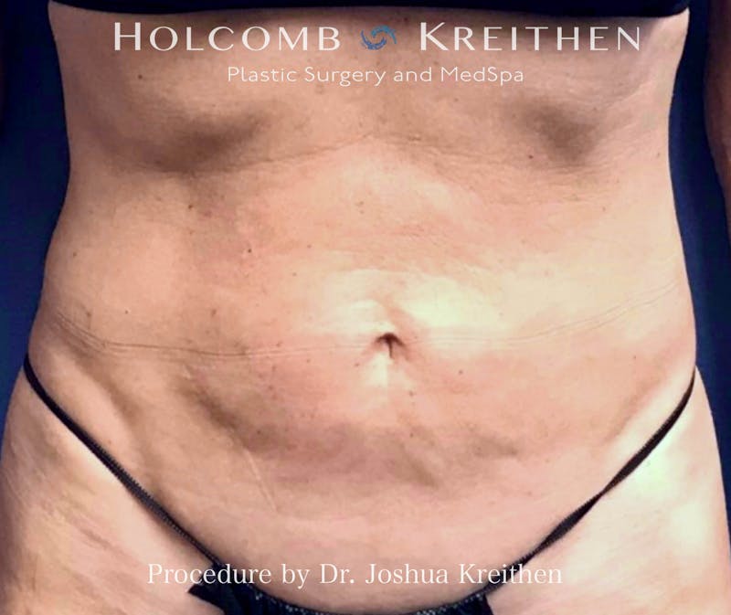Morpheus  Before & After Gallery - Patient 181326 - Image 1