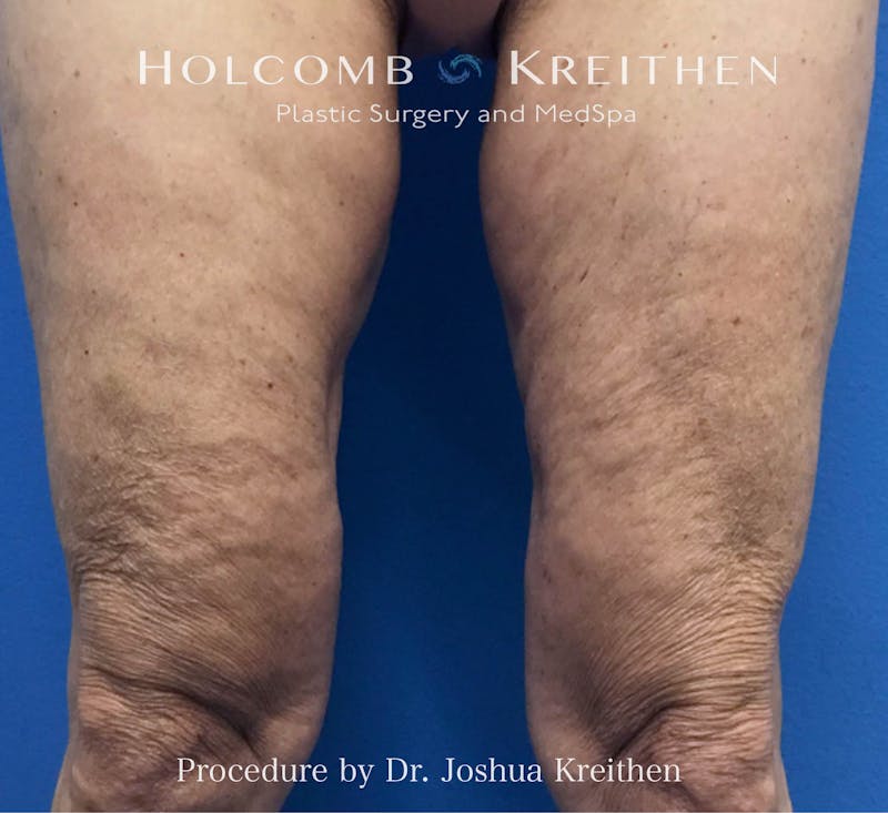 Morpheus  Before & After Gallery - Patient 285073 - Image 1