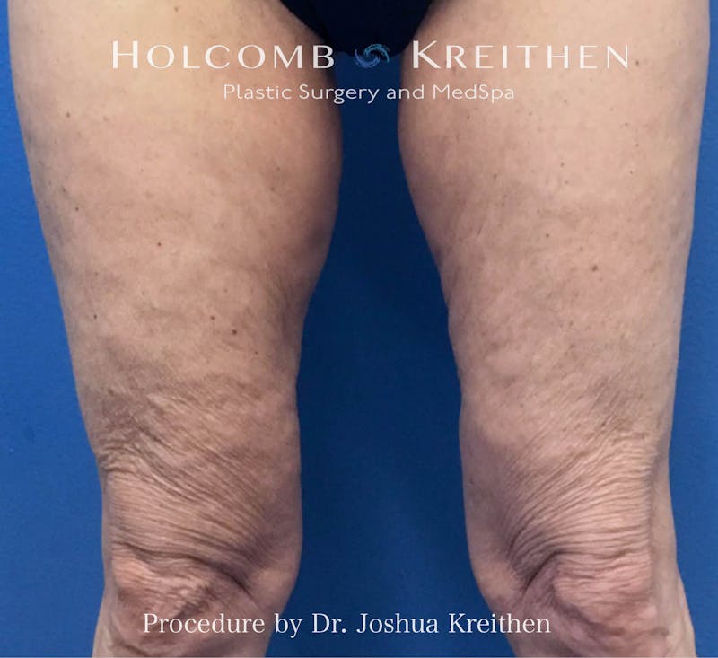 Morpheus  Before & After Gallery - Patient 285073 - Image 2