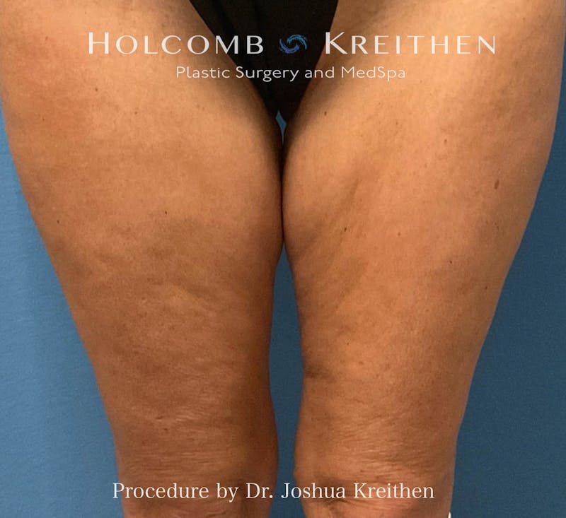 Morpheus  Before & After Gallery - Patient 836366 - Image 1