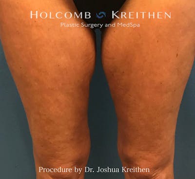 Morpheus  Before & After Gallery - Patient 836366 - Image 2