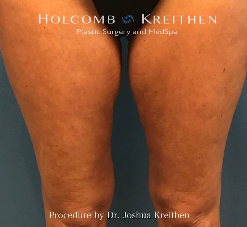 Morpheus  Before & After Gallery - Patient 836366 - Image 2