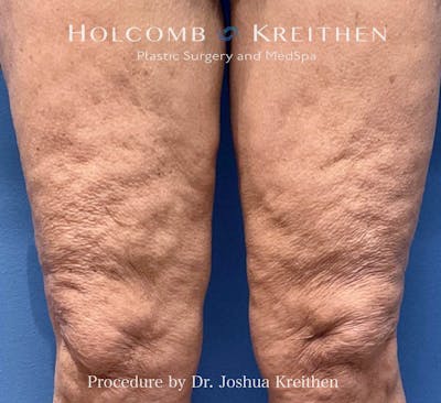 Morpheus  Before & After Gallery - Patient 131583 - Image 1