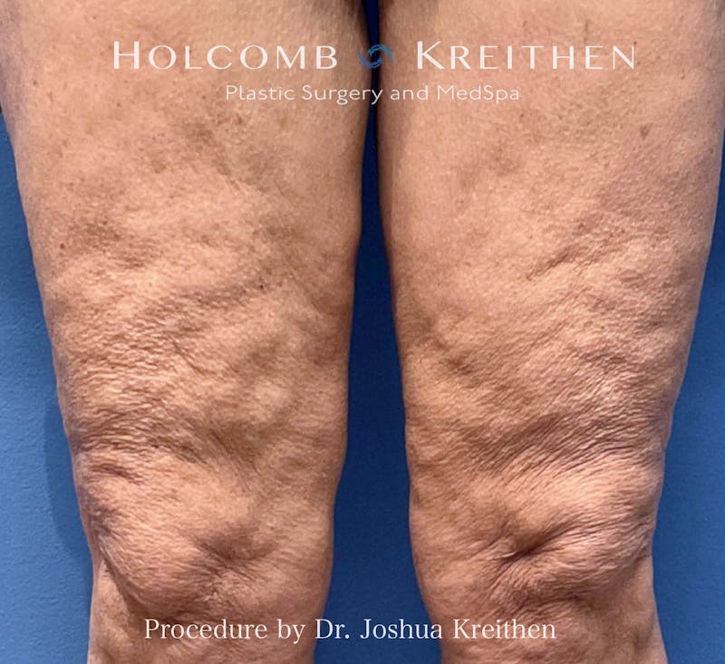 Morpheus  Before & After Gallery - Patient 131583 - Image 1