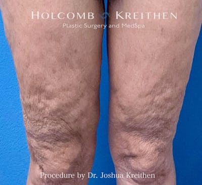 Morpheus  Before & After Gallery - Patient 131583 - Image 2