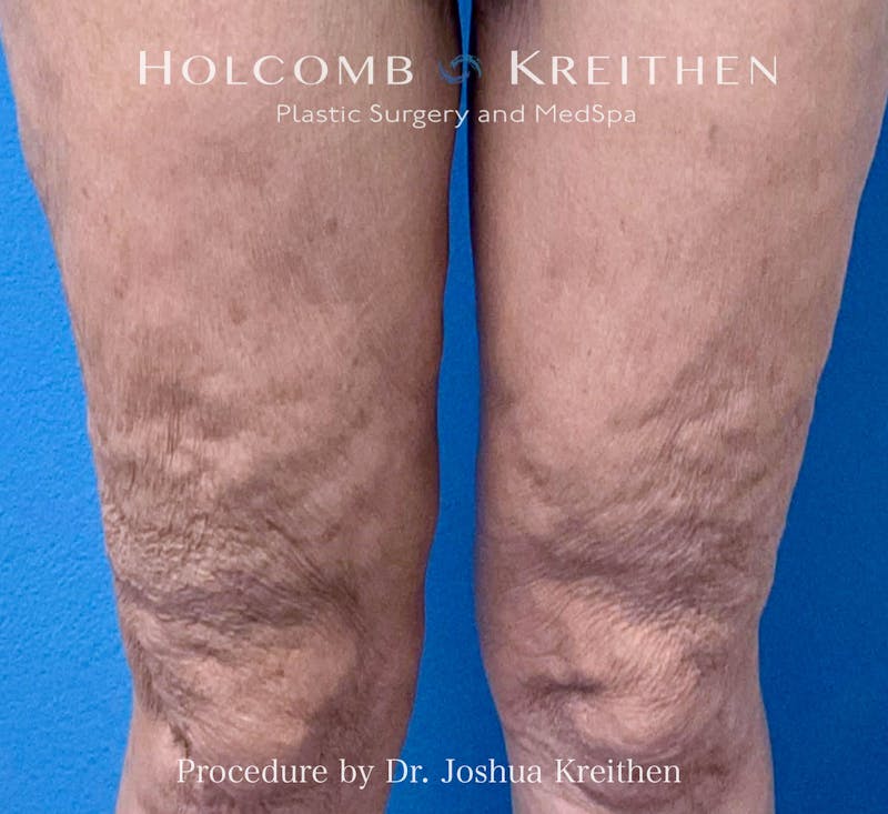Morpheus  Before & After Gallery - Patient 131583 - Image 2