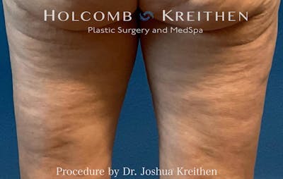 Morpheus  Before & After Gallery - Patient 164023 - Image 1