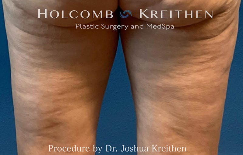 Morpheus  Before & After Gallery - Patient 164023 - Image 1