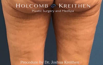 Morpheus  Before & After Gallery - Patient 164023 - Image 2