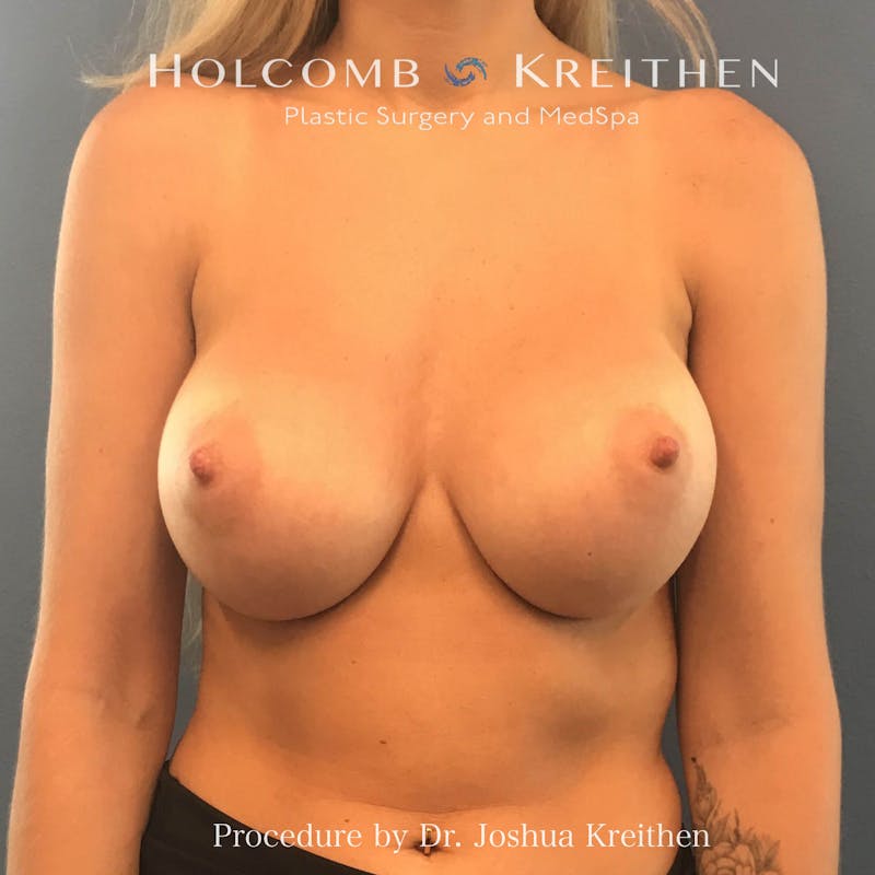 Breast Augmentation Before & After Gallery - Patient 976749 - Image 2