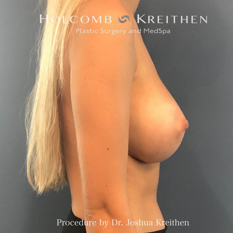 Breast Augmentation Before & After Gallery - Patient 976749 - Image 6