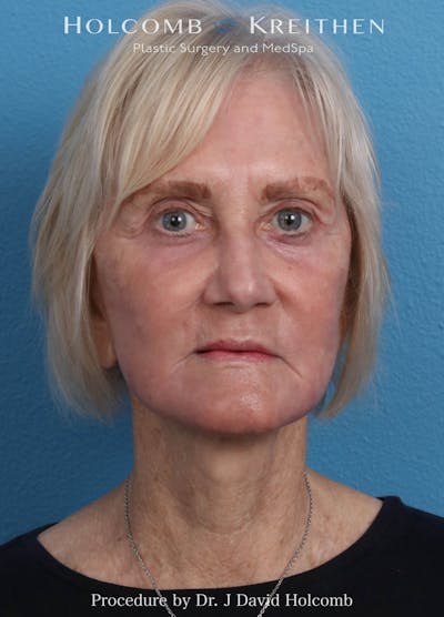 Facelift Before & After Gallery - Patient 407479 - Image 2