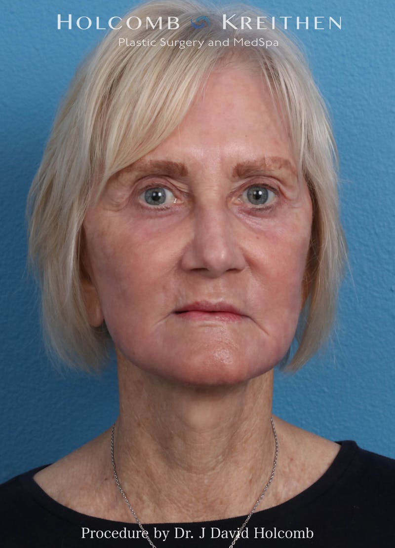 Facelift Before & After Gallery - Patient 407479 - Image 2