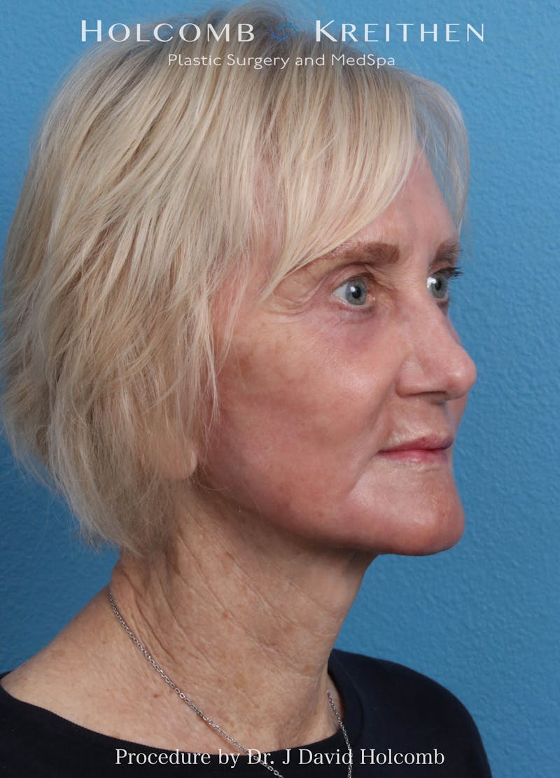 Facelift Before & After Gallery - Patient 407479 - Image 4