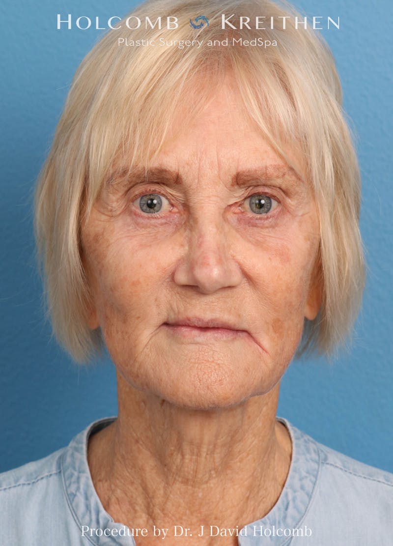 Facelift Before & After Gallery - Patient 407479 - Image 1
