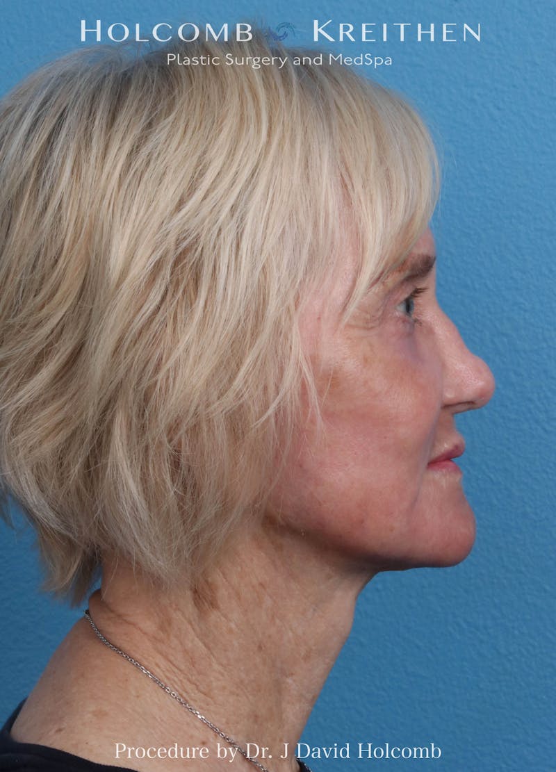 Facelift Before & After Gallery - Patient 407479 - Image 6