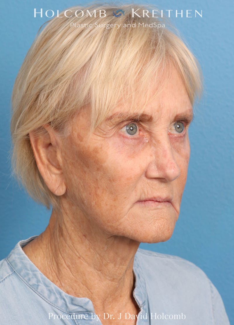 Facelift Before & After Gallery - Patient 407479 - Image 3