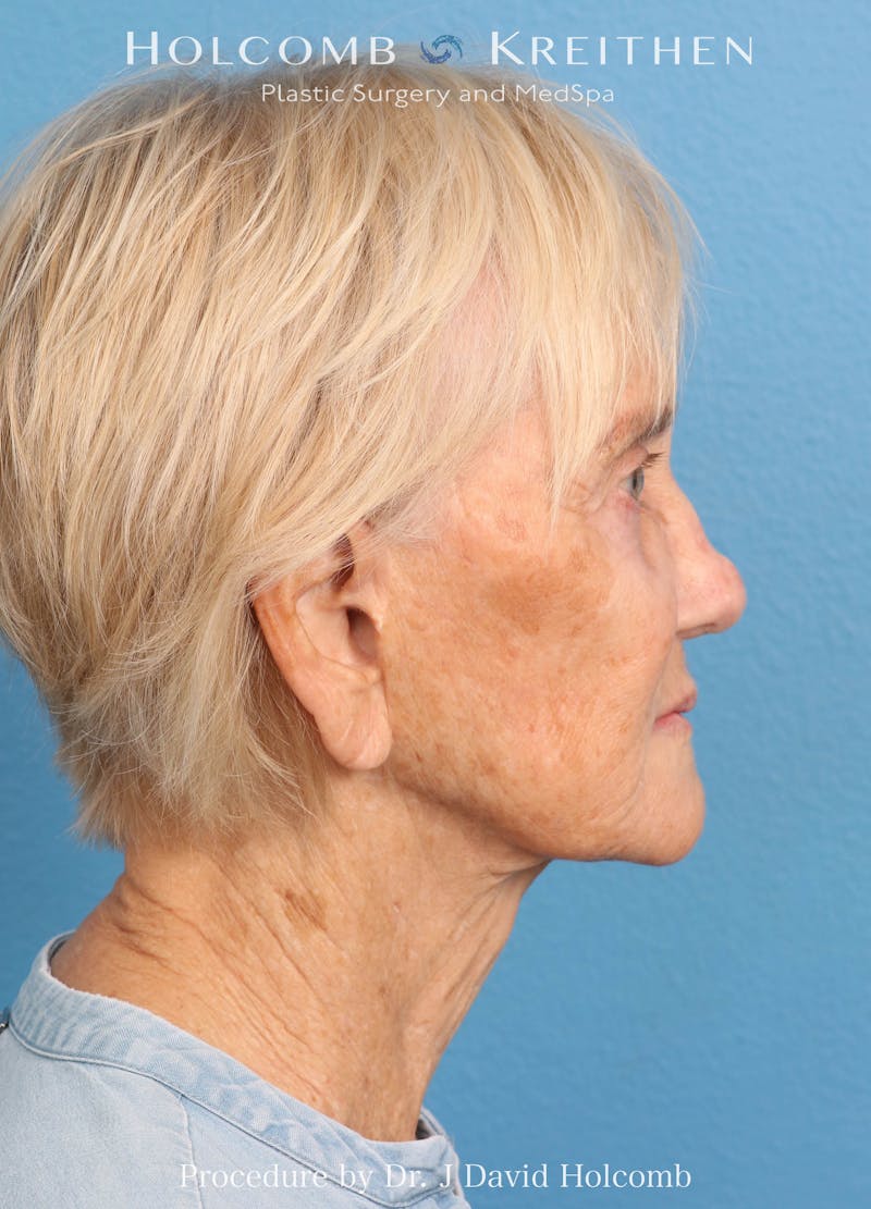 Facelift Before & After Gallery - Patient 407479 - Image 5