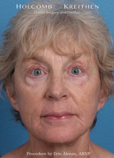 BBL Laser Before & After Gallery - Patient 259972 - Image 2