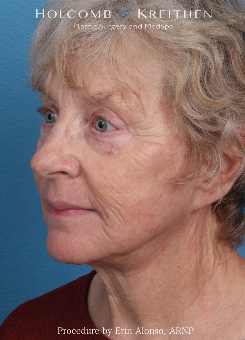 BBL Laser Before & After Gallery - Patient 259972 - Image 4