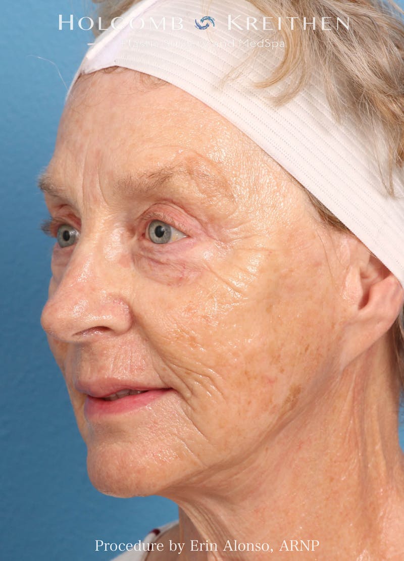 BBL Laser Before & After Gallery - Patient 259972 - Image 3
