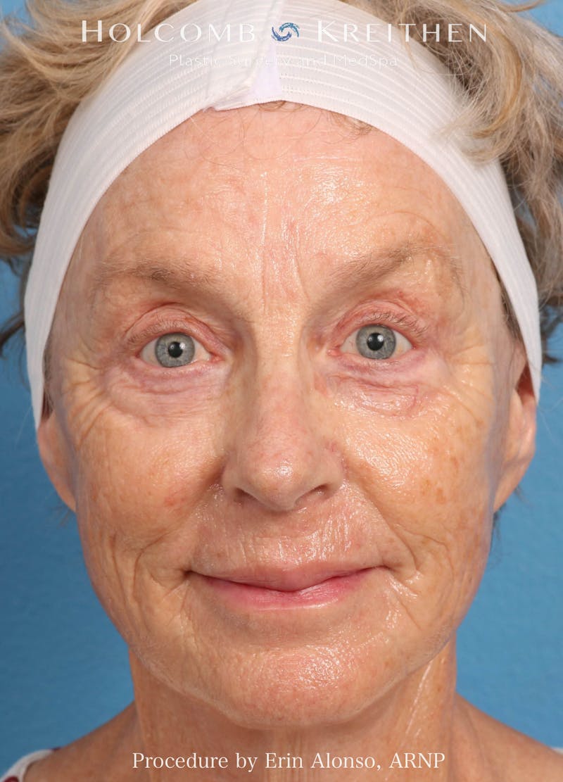 BBL Laser Before & After Gallery - Patient 259972 - Image 1