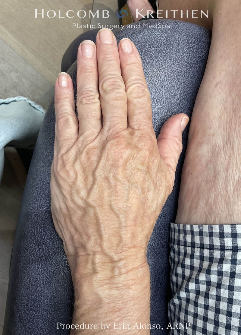 BBL Laser Before & After Gallery - Patient 193841 - Image 2