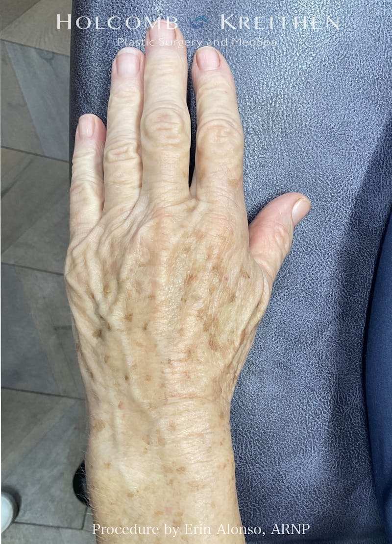 BBL Laser Before & After Gallery - Patient 193841 - Image 1