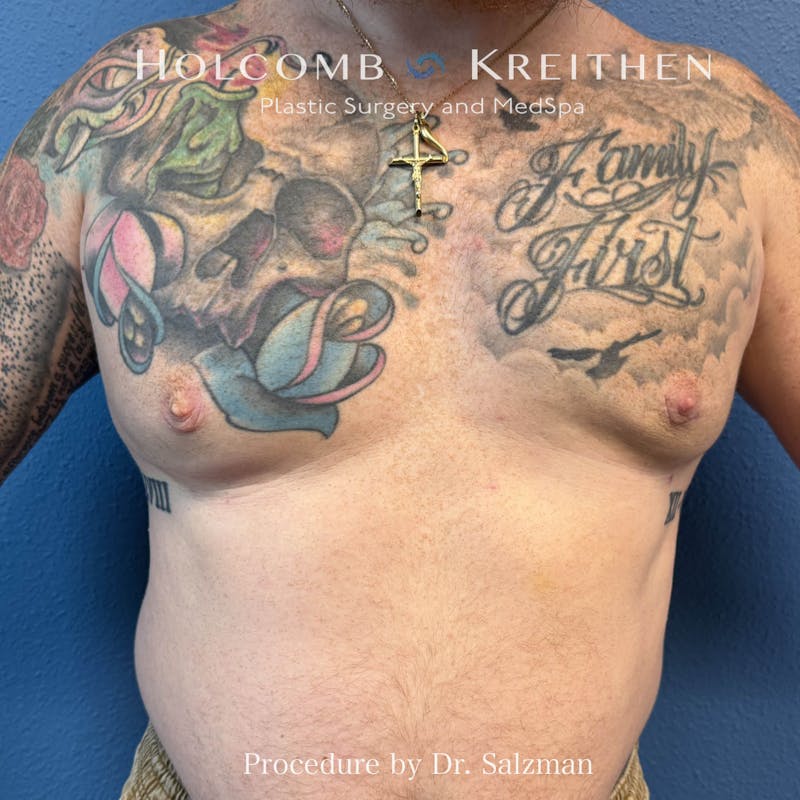 Gynecomastia Before & After Gallery - Patient 444610 - Image 2