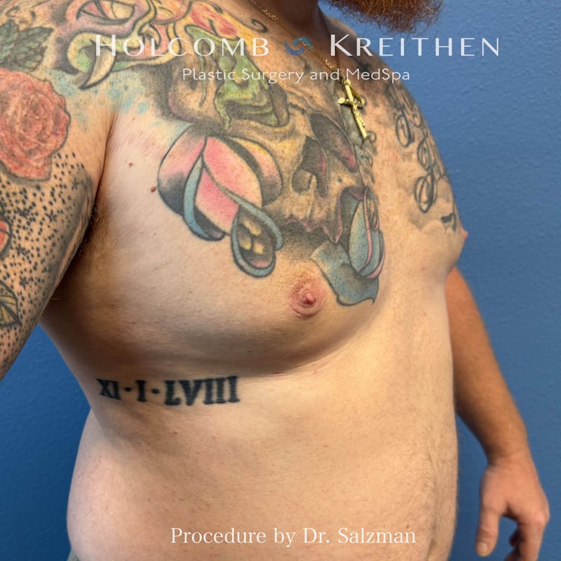 Gynecomastia Before & After Gallery - Patient 444610 - Image 4