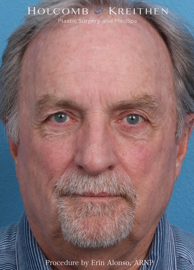 BBL Laser Before & After Gallery - Patient 196679 - Image 2