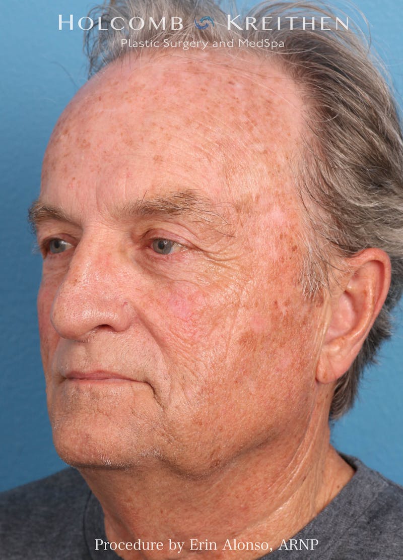 BBL Laser Before & After Gallery - Patient 196679 - Image 3
