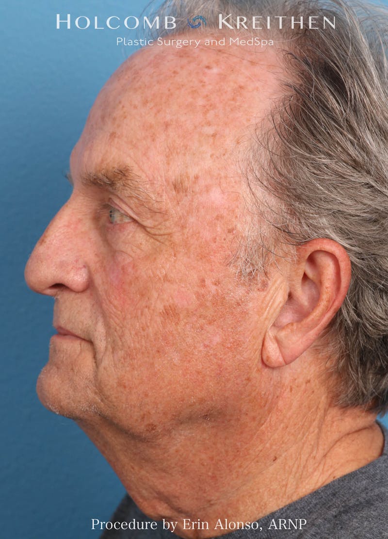 BBL Laser Before & After Gallery - Patient 196679 - Image 5