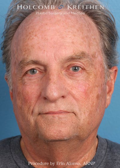 TRL Laser Skin Resurfacing Before & After Gallery - Patient 307706 - Image 1