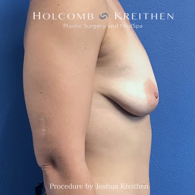 Motiva Breast Implants Before & After Gallery - Patient 249091 - Image 5