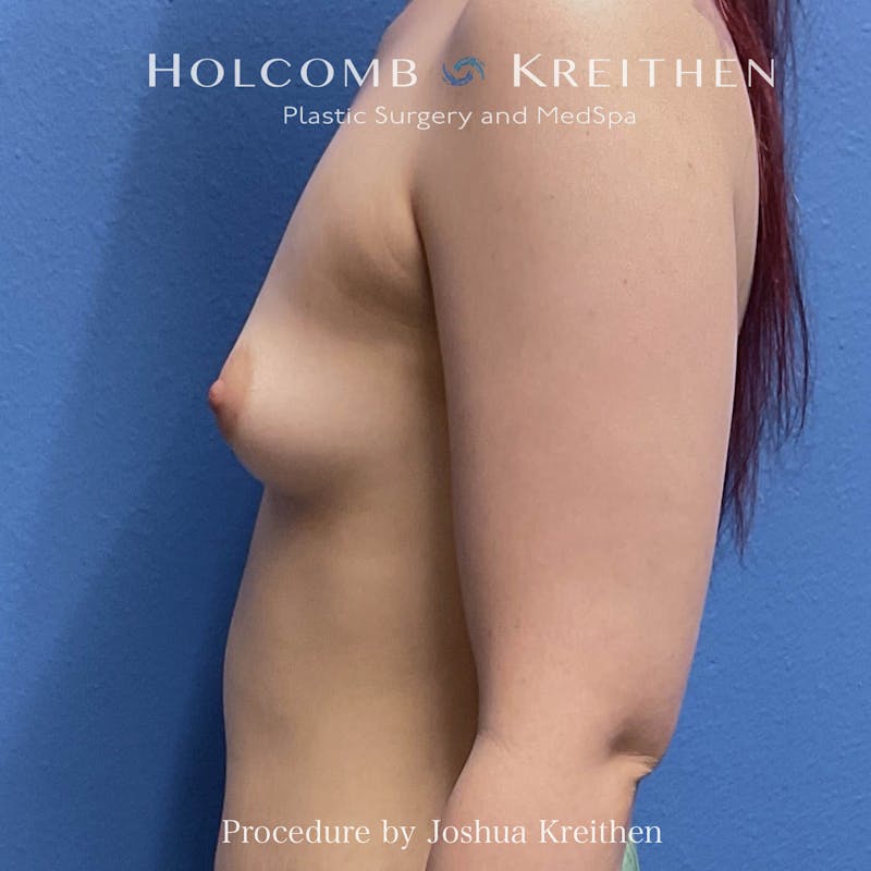 Motiva Breast Implants Before & After Gallery - Patient 278717 - Image 5