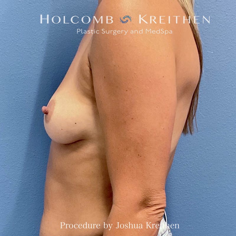 Motiva Breast Implants Before & After Gallery - Patient 183053 - Image 5