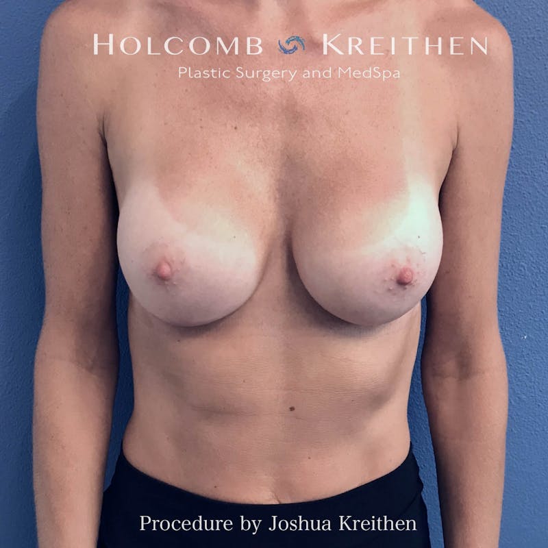 Motiva Breast Implants Before & After Gallery - Patient 883471 - Image 2
