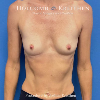 Motiva Breast Implants Before & After Gallery - Patient 883471 - Image 1