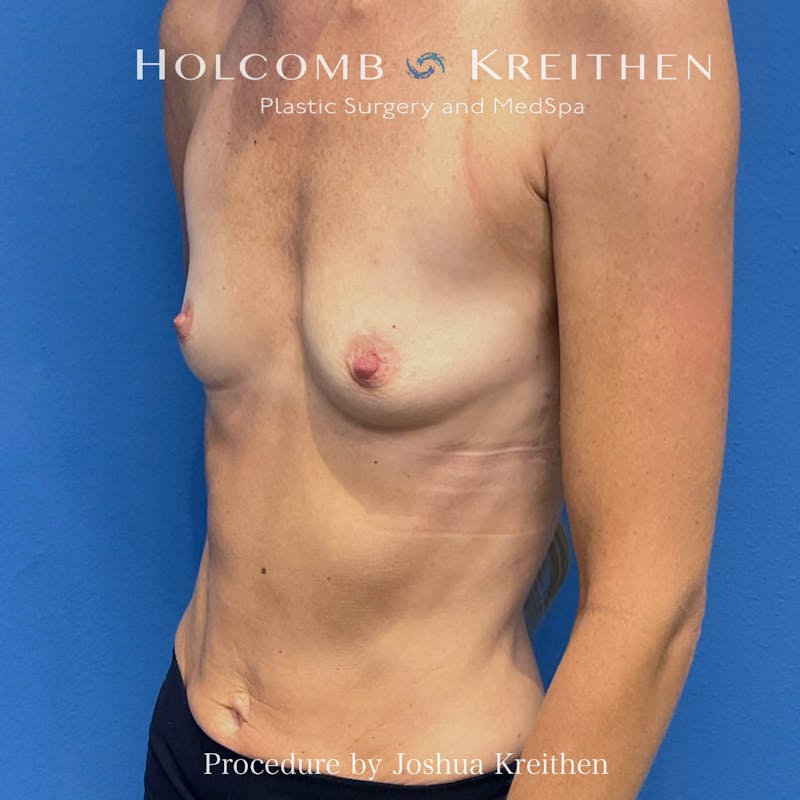 Motiva Breast Implants Before & After Gallery - Patient 883471 - Image 3