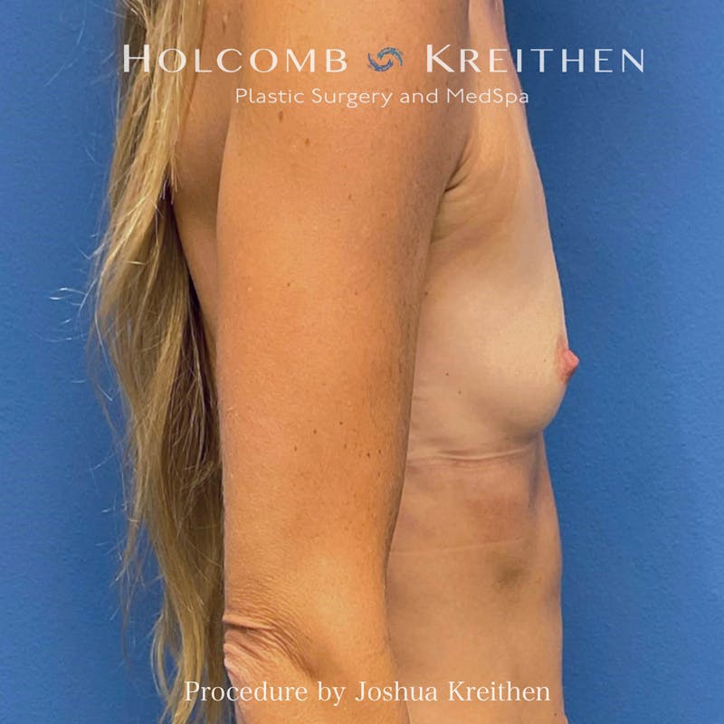 Motiva Breast Implants Before & After Gallery - Patient 883471 - Image 5